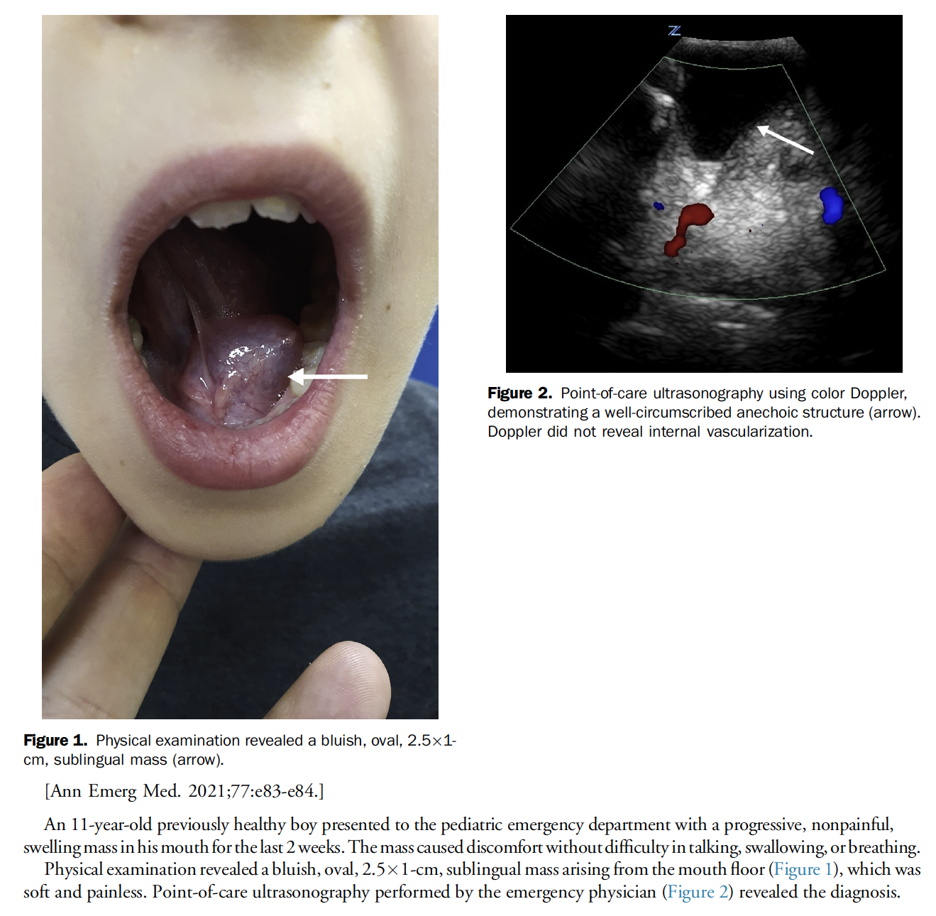 Pediatric Ranula March 2021 Monthly Review | Internet Book of Emergency Medicine