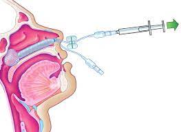 Epistaxis- May 2021 | Internet Book of Emergency Medicine